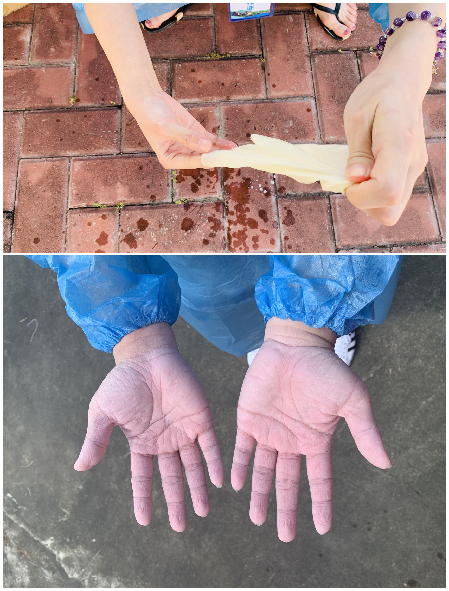 防疫一線工作人員的雙手：脫掉手套，在汗水和消毒液浸泡下發(fā)皺變白.jpg